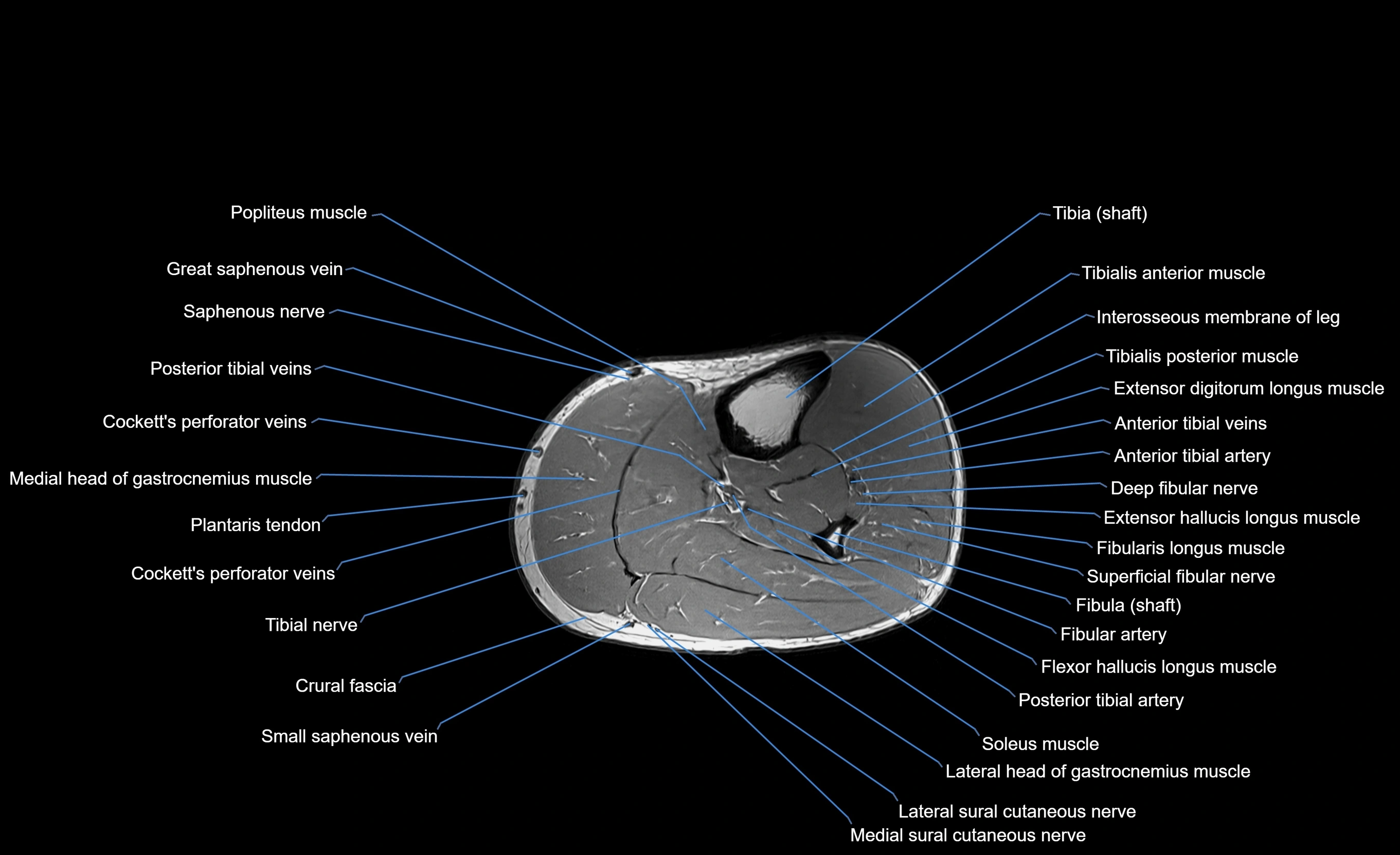 MRI lower leg axial cross sectional anatomy 3T  radiology  image-img-00001-00037.webp